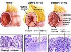 慢性潰瘍結(jié)腸炎的并發(fā)癥