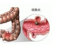 什么是結(jié)腸炎？結(jié)腸炎的癥狀有哪些？